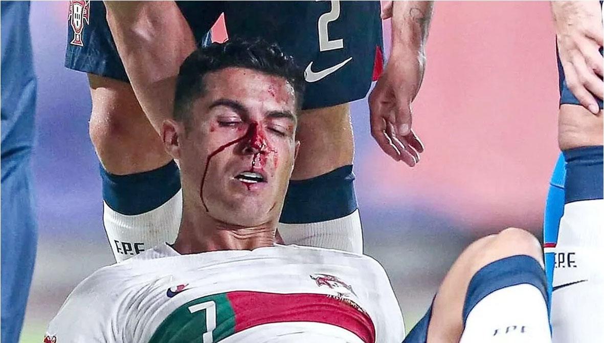 Cristiano Ronaldo a avut nevoie de îngrijiri medicale, după ce portarul ceh Tomas Vaclik l-a umplut de sânge în minutul 12
